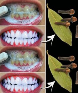 Rimuovi il tartaro e sbianca i denti in modo naturale